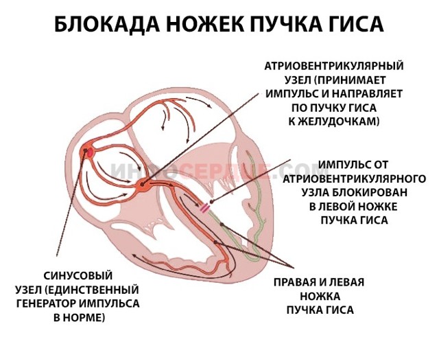 Неполная блокада левой ножки пучка Гиса - причины, лечение