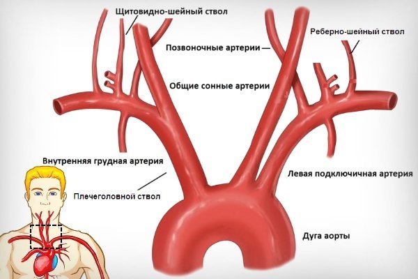 Нестенозирующий атеросклероз внечерепных отделов брахиоцефальных артерий - Всё о сердце