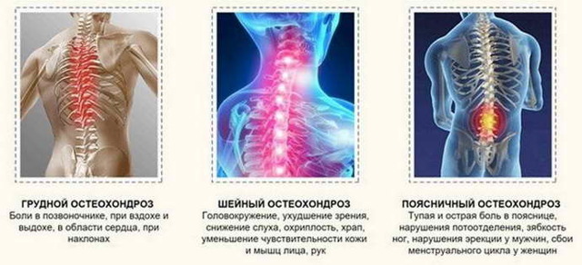 Боль в грудине при остеохондрозе