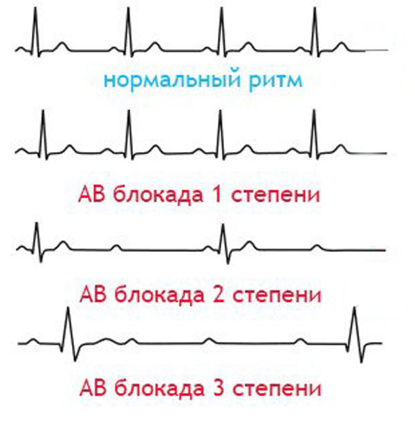 Что такое блокада сердца 1 степени