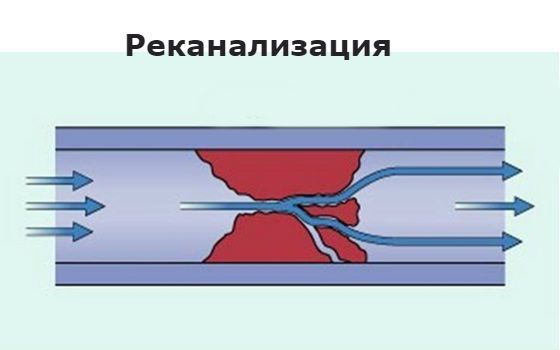Фибринолитическая активность (в крови)