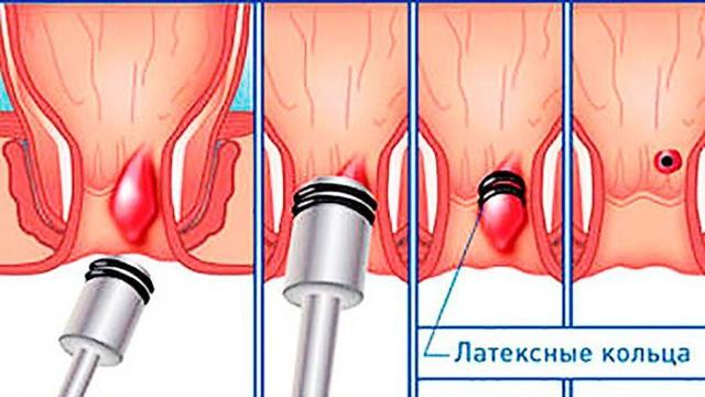 Что нужно делать если геморрой вылез наружу и болит