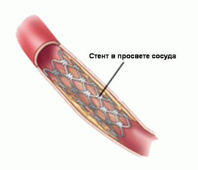 Бифуркация - это раздвоение трахеи, аорты или сонной артерии