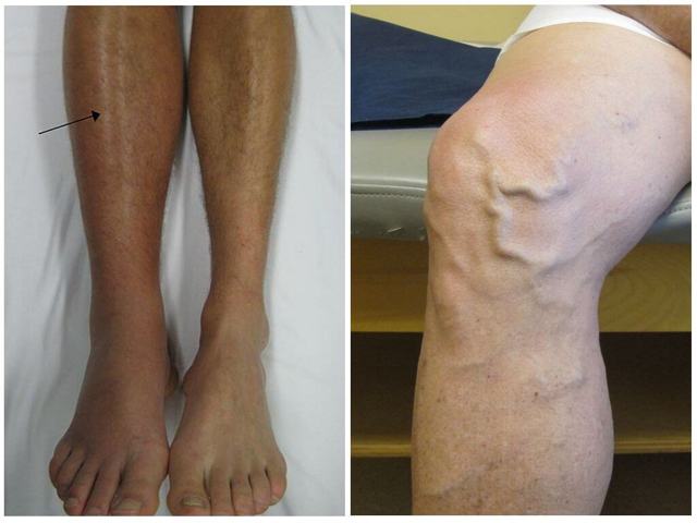 Отеки при варикозе - снимаем быстро и надолго