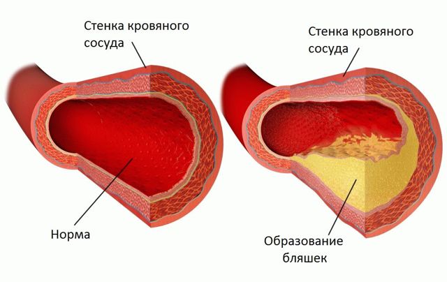 Нормы холестерина в крови у женщин: изменения по возрасту