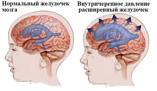 Расширение желудочков головного мозга у новорожденных