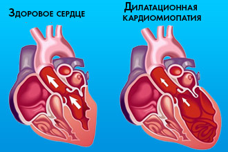 Дисметаболическая кардиомиопатия: симптомы и лечение