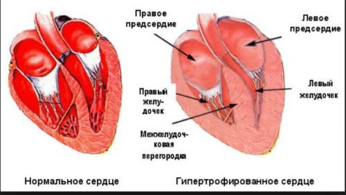 ЭКГ. Гипертрофия правого желудочка. Характерные признаки гипертрофии правого желудочка на ЭКГ