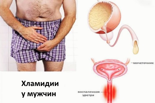 Хламидиоз: у мужчин, женщин; фото, симптомы и лечение