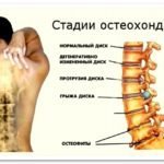 ХОНДРОИТИН: ИНСТРУКЦИЯ ПО ПРИМЕНЕНИЮ, ЦЕНА, ОТЗЫВЫ, АНАЛОГИ КАПСУЛ ХОНДРОИТИН
