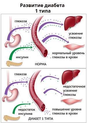 Сахарный диабет 1 типа: причины и признаки