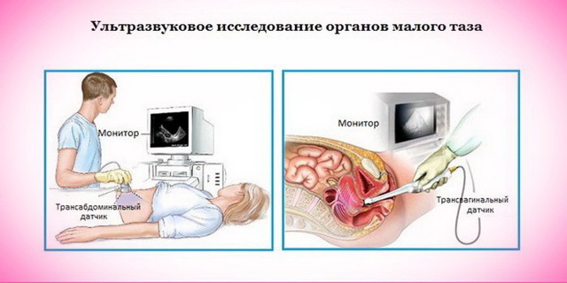 Застой крови в малом тазу у женщин и мужчин: симптомы, лечение, причины