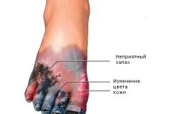 Лечение гангрены народными средствами в домашних условиях