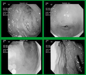 Эрозивный гастрит – симптомы, лечение, диета, осложнения, профилактика