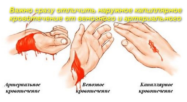 Первая помощь при капиллярном кровотечении - ОРЗ нет!