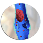 Варикоз, варикозное расширение вен ног: лечение, симптомы