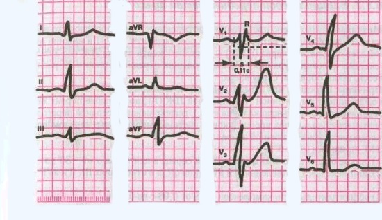 Неполная блокада правой ножки пучка Гиса – вид на ЭКГ