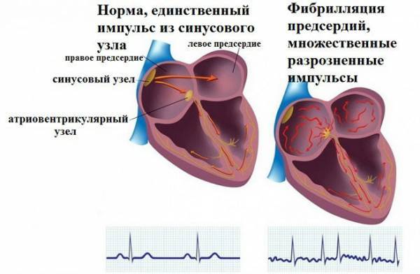 Картинки ЭКГ при нарушениях ритма