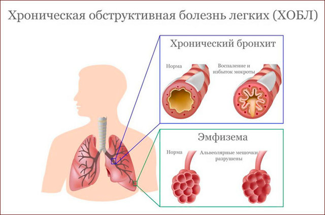 Какие существуют болезни легких