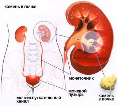 Боль, жжение и рези при мочеиспускании у женщин и мужчин: причины и лечение