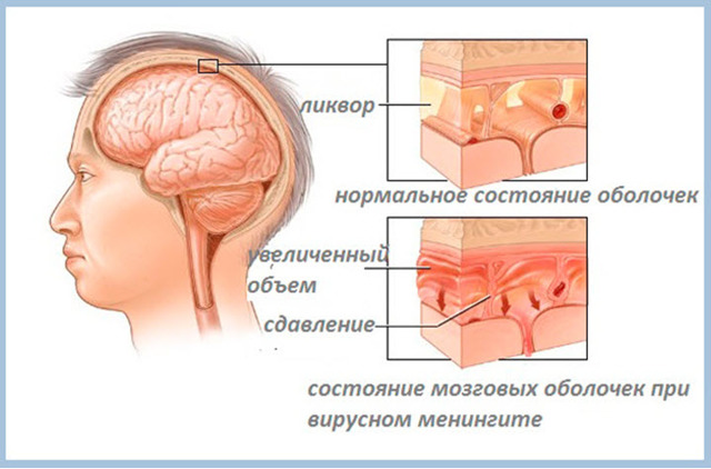Могут ли желудочки головного мозга уменьшится сами. Расширение боковых желудочков головного мозга