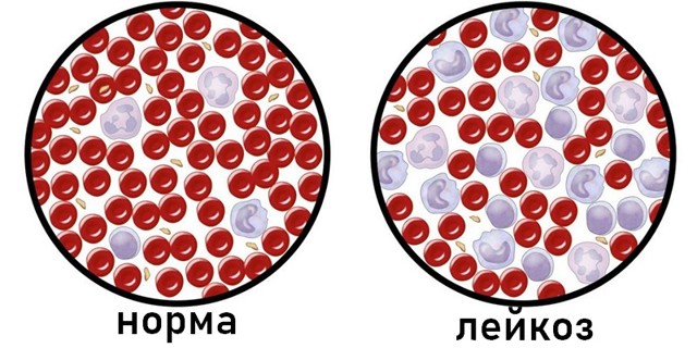 Рак крови – симптомы, признаки, стадии, диагностика и лечение