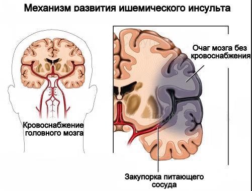 Повторный ишемический инсульт выживаемость - Инсульт