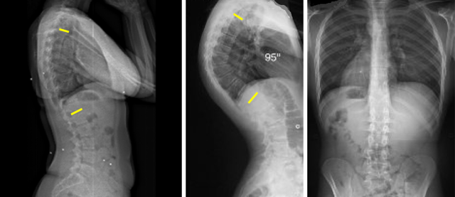 Как убрать горб на спине: эффективные способы лечения