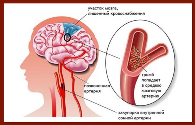 Медикаментозное лечение атеросклероза сосудов головного мозга препаратами