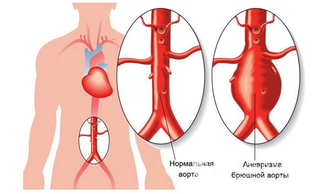 Аневризма аорты. Клиника аневризмы аорты
