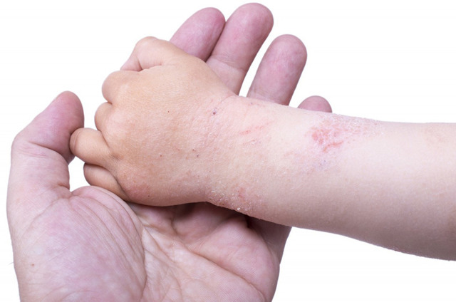 Нейродермит у взрослых и детей: симптомы (фото), лечение