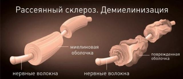Единичные очаги в белом веществе головного мозга - результаты МРТ