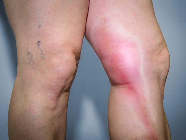 Пароксизмальная холодовая гемоглобинурия. Гемолитические анемии на почве изоиммунных тел.