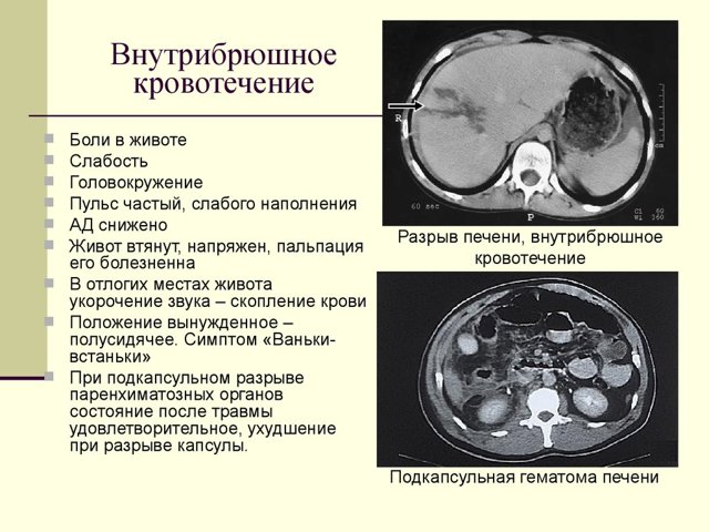 Внутреннее кровотечение в животе: признаки и первая помощь
