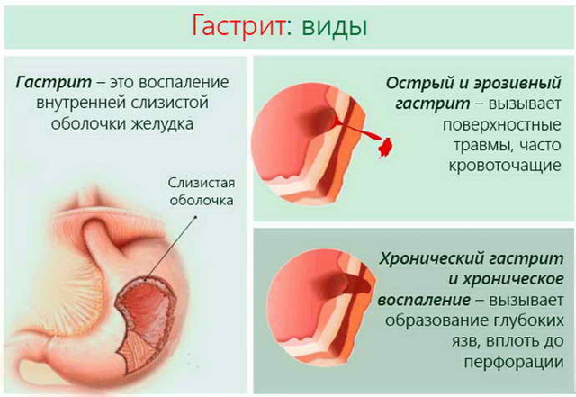 Белый налет на языке у взрослых: причины. Почему на языке белый налет, что это значит и как лечить