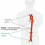 Тромб в сонной артерии: лечение, симптомы и удаление