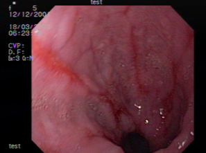Через сколько проходит геморрой после родов? - Mamapedia