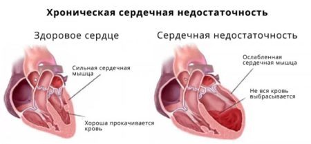 Бидоп – инструкция по применению, при каком давлении назначают