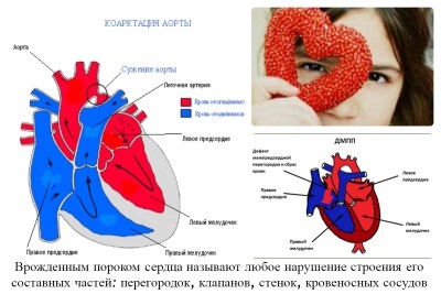 Врожденный порок сердца у новорожденных детей: что это, причины, последствия, классификация и лечение