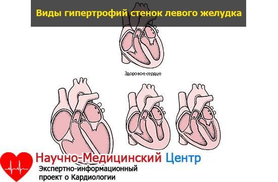 Утолщение стенок сердца - Все про гипертонию