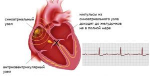 Блокада сердца 1–2 степени — что такое и как лечить?