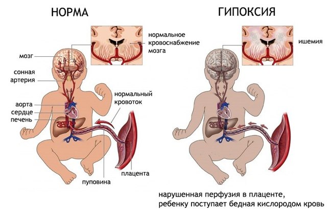 Гемодинамические нарушения 1 а степени при беременности