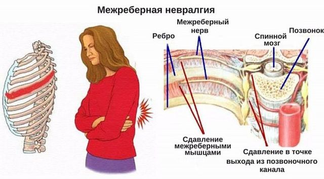 Болит грудь сбоку: причины и симптомы
