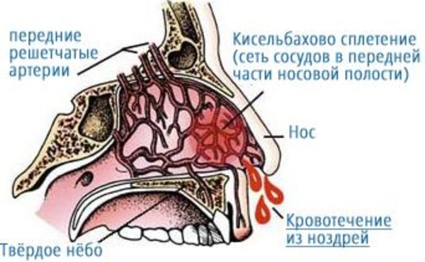 Причины носового кровотечения у ребенка. Как остановить кровь из носа
