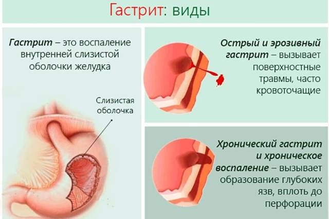 Папаверин при запорах у детей - Лечение гастрита