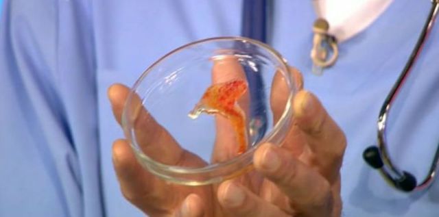 Мокрота с кровью при кашле – кровь в слизи при отхаркивании 2019