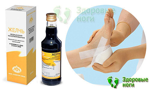 Пяточная шпора - симптомы и лечение в домашних условиях эффективными способами