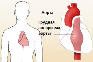Аневризма грудного отдела аорты: диагностика и лечение
