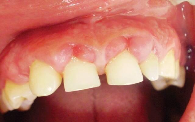 Острый, язвенно-некротический гингивит Венсана: лечение, симптомы и диагностика