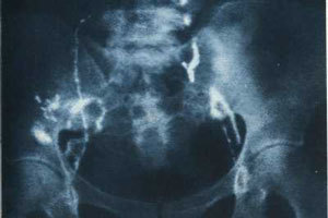 Сколько живут с раком шейки матки 4 стадии и есть ли шансы?